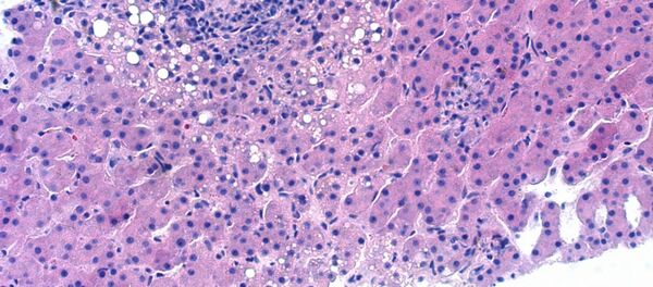 Mycobacterium avium-complex granulomatous hepatitis Mycobacterium avium-complex granulomatous hepatitis - Sputnik Latvija