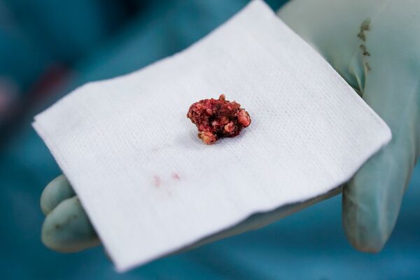 Удаленная опухоль - Sputnik Латвия